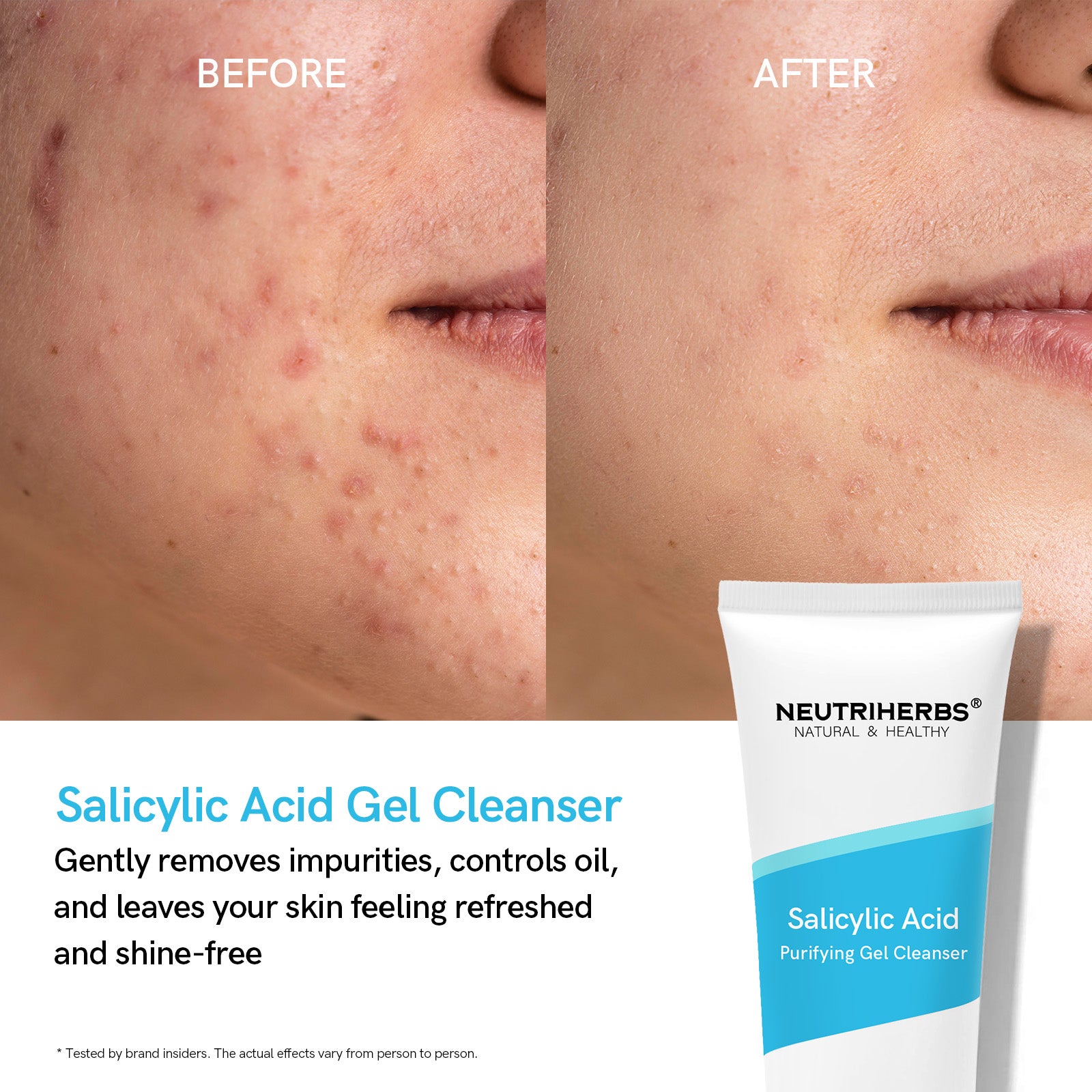 Salicylic Acid Cleanser For Acne Prone Skin
