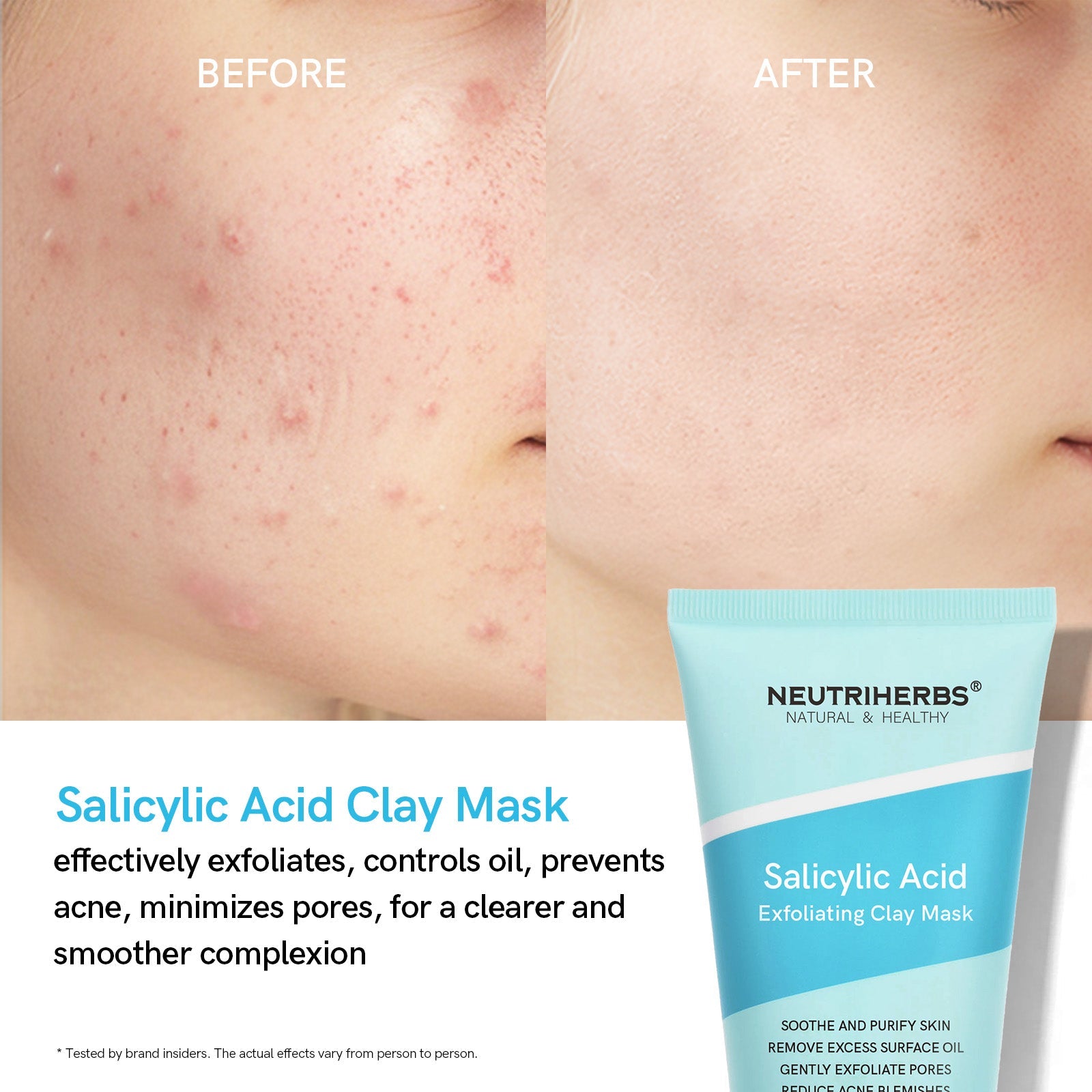 Salicylic Acid Clay Mask For Oily Skin