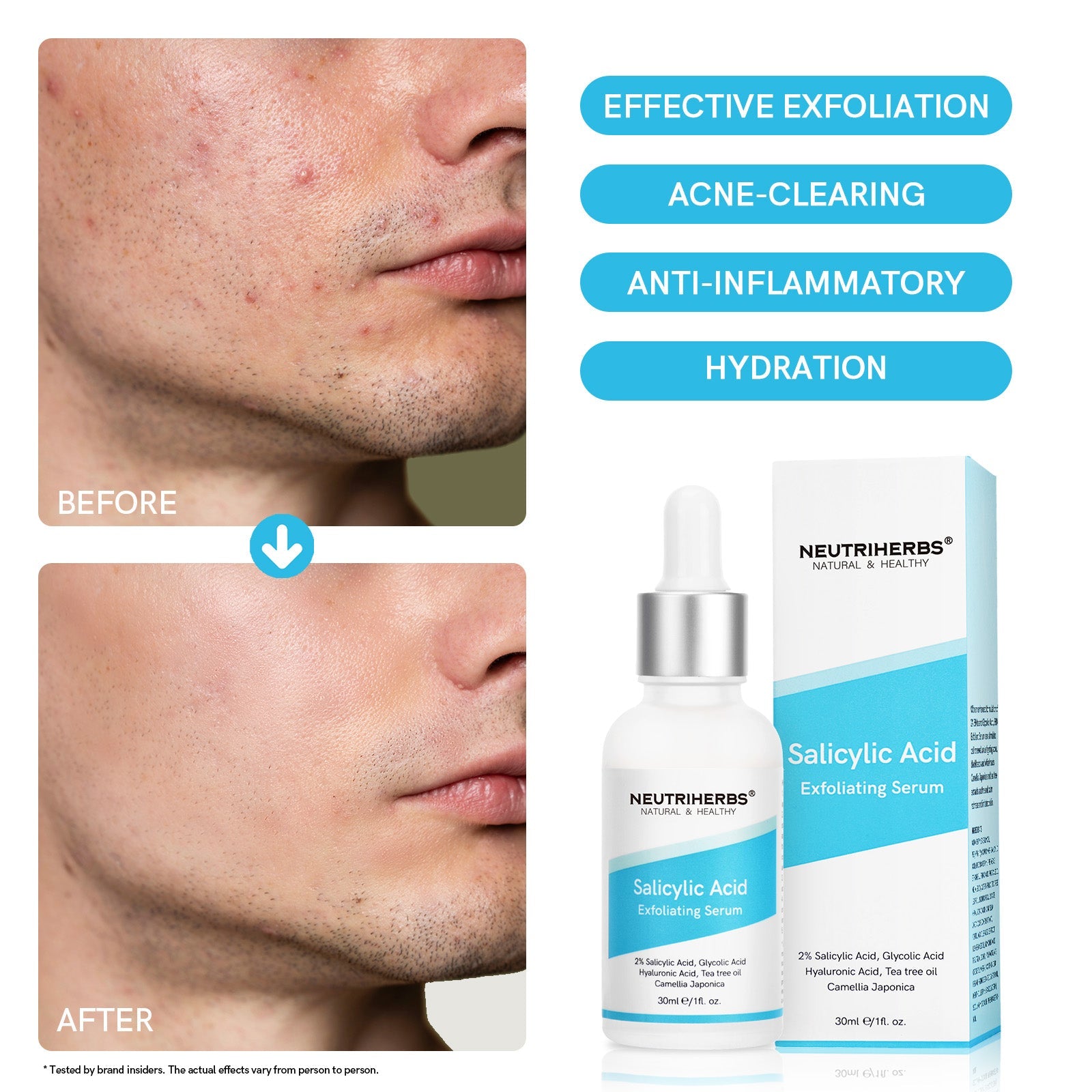 Salicylic Acid Serum For Acne Prone Skin