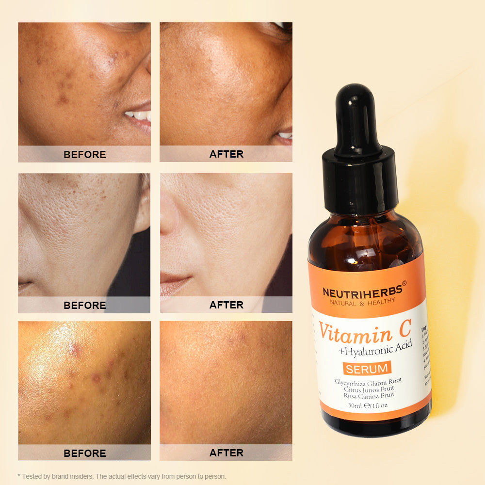 Vitamin C Serum Helps Lighten And Brighten Your Skin